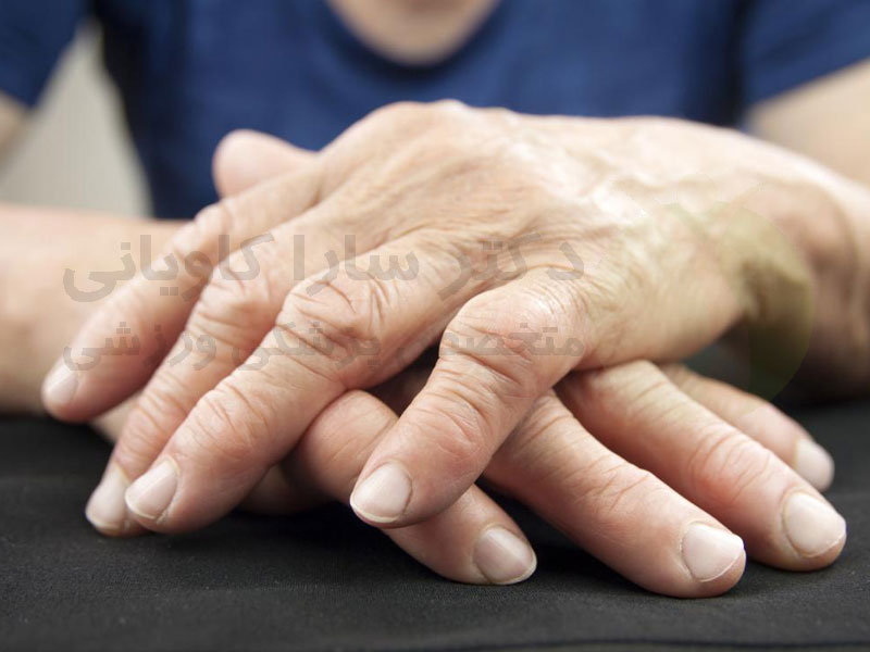 تشخیص آرتروز دست
