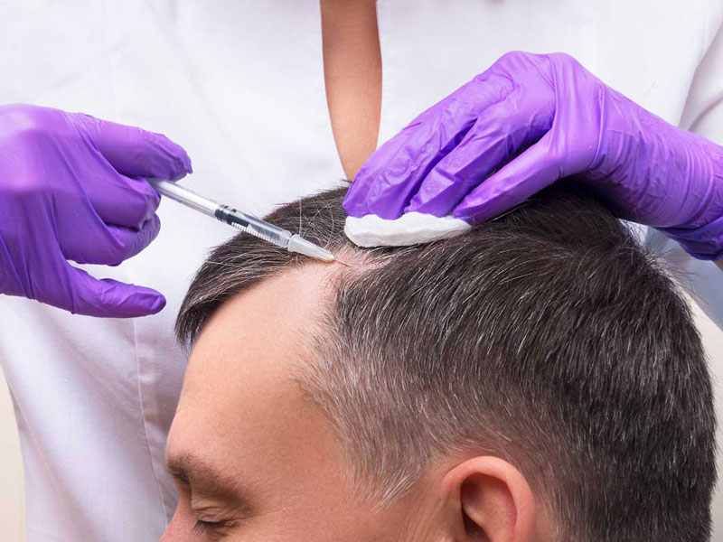 PRP - درمان ریزش مو