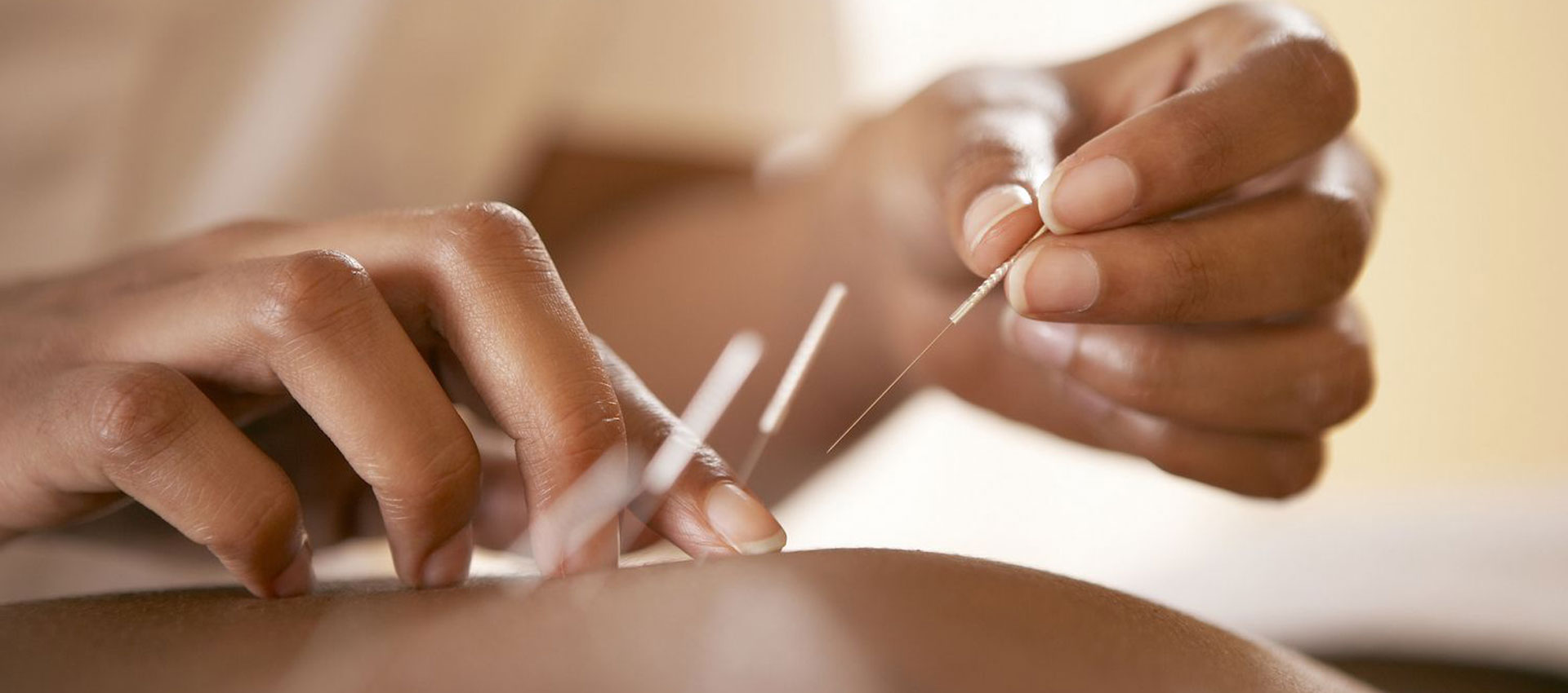 چلونگر طب سوزنی چلونگر طب سوزنی